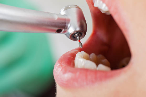 Best Emergency Dental Care for Abscessed Tooth in St Paul, VA